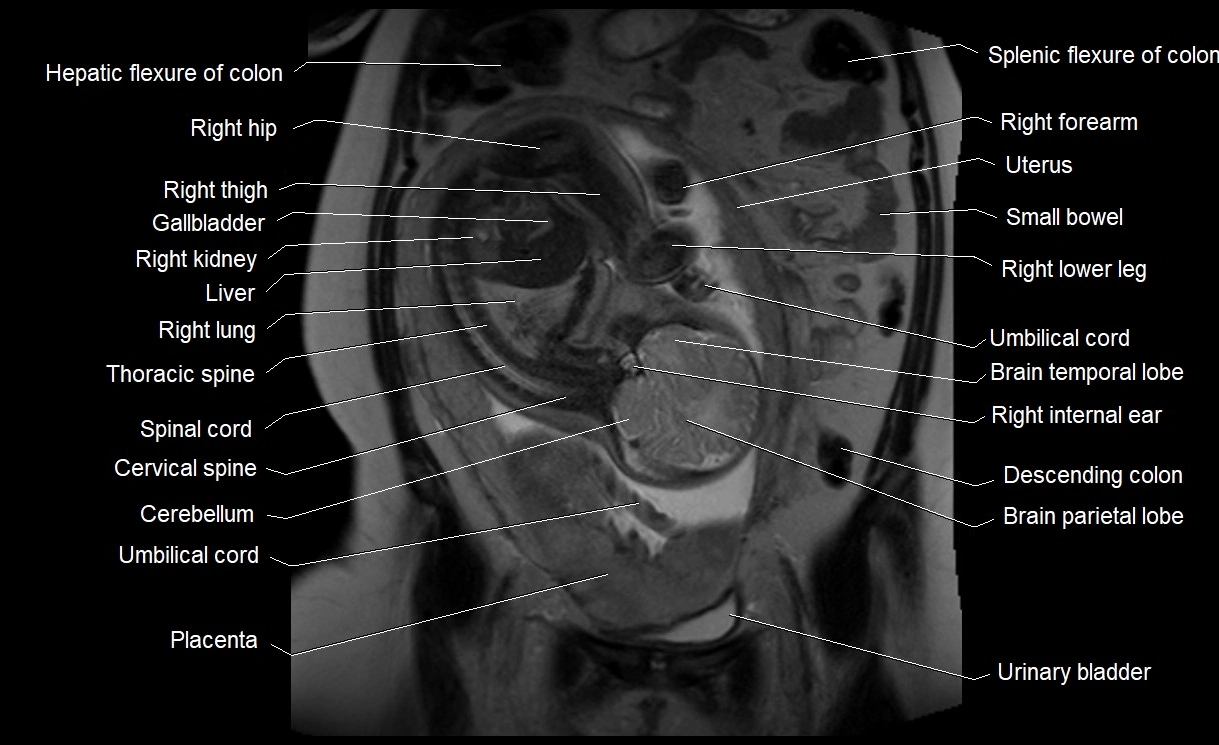 MRI Anatomy of pregnancy image 15.webp
